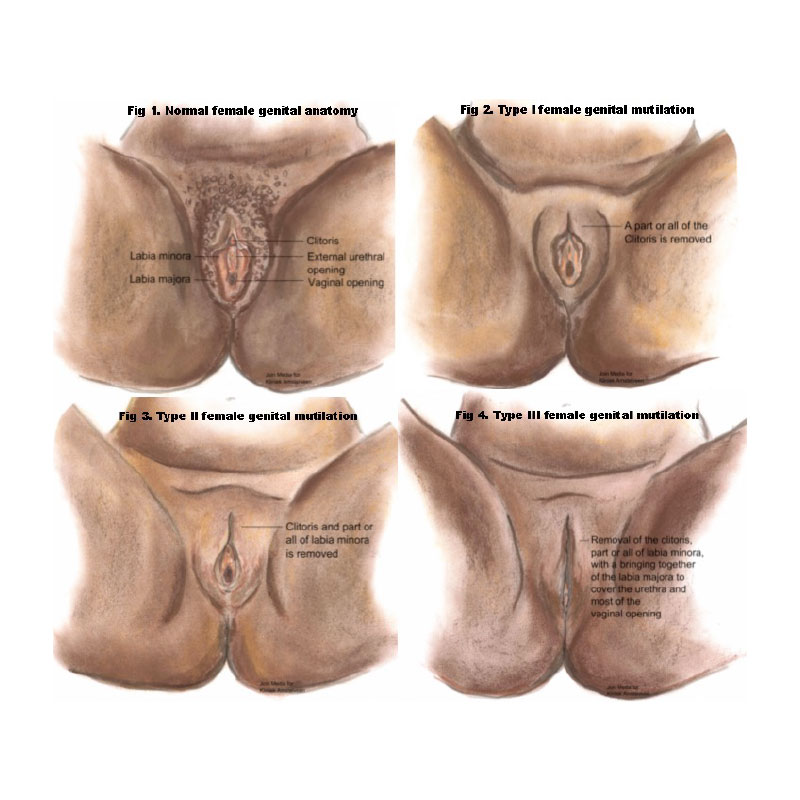 Vier-typen-besnijdenissen-voor-vrouwen